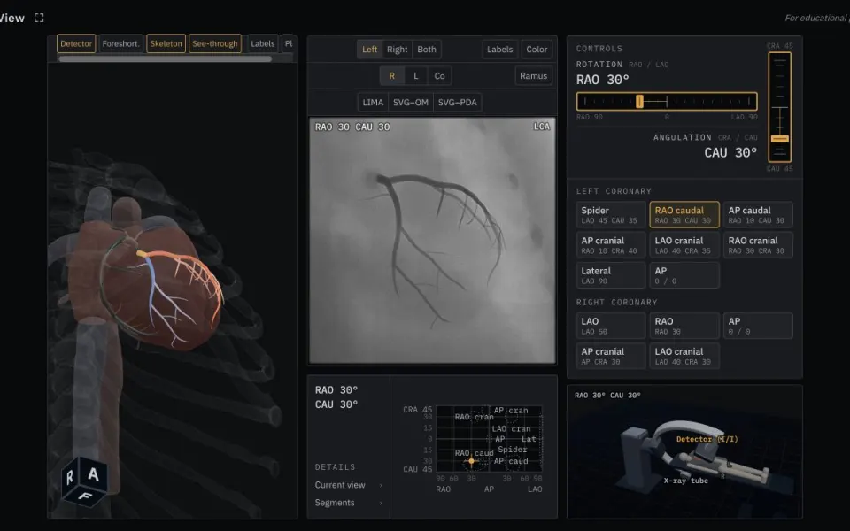 AngioView: a 3D heart in a translucent chest, a simulated angiogram at RAO 30 CAU 30, and the C-arm controls.