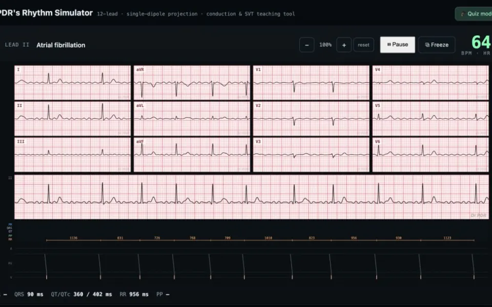 CardioRender Rhythm Simulator: the atrial fibrillation preset with the ladder diagram.