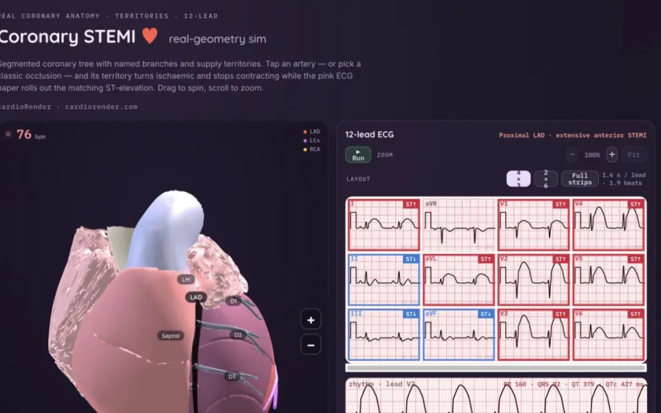 CardioRender STEMI Simulator: proximal LAD selected, with the territory and the 12-lead.