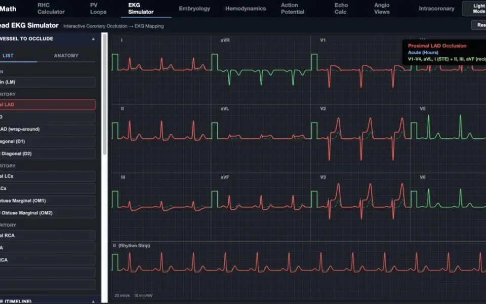 CathMath 12-Lead EKG Simulator: the proximal LAD preset.