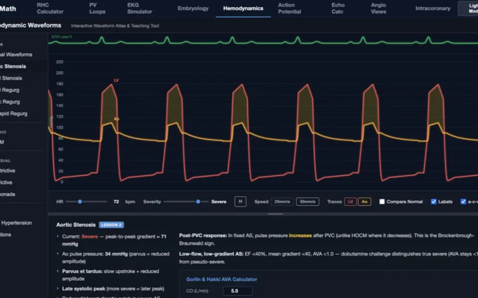 CathMath Hemodynamic Waveforms: the aortic stenosis preset with its severity controls.