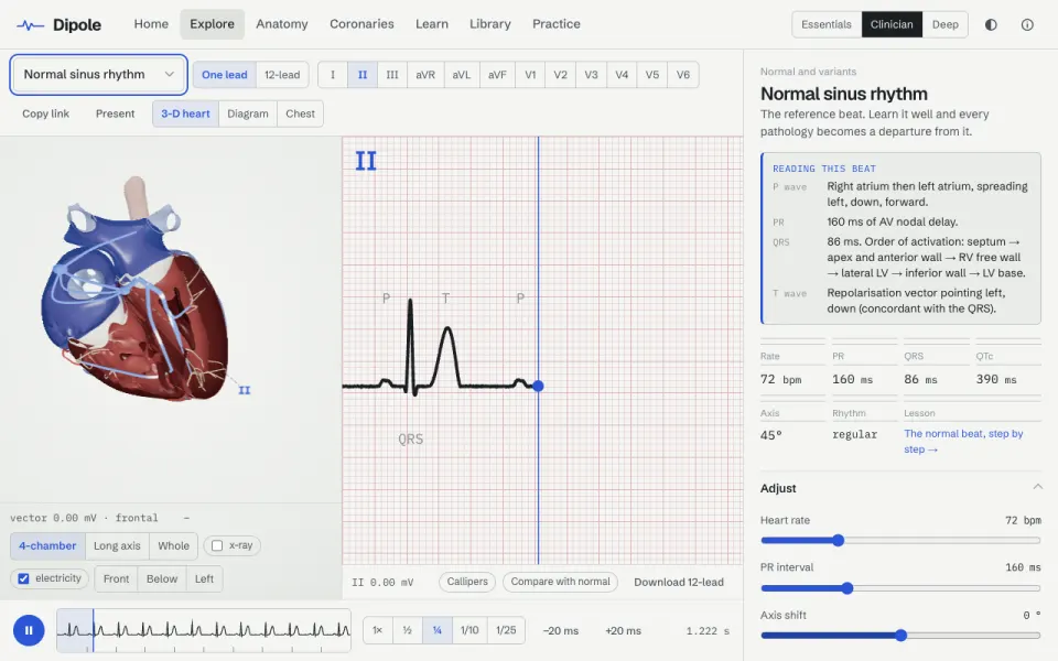 Dipole: a 3D heart with its electrical activation beside a live lead II tracing on ECG paper.