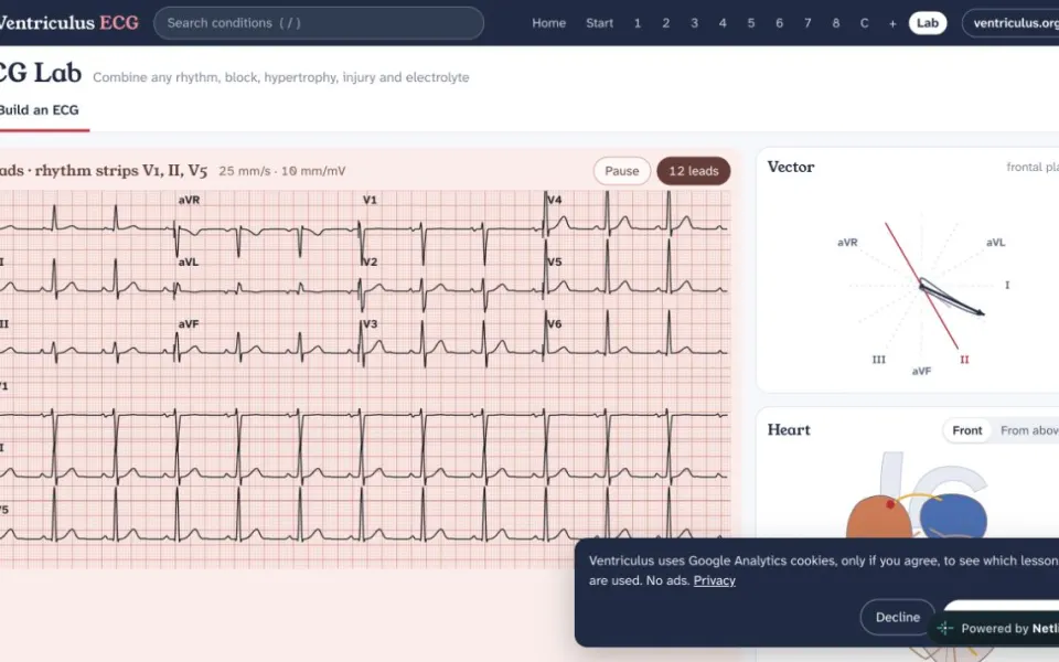 Ventriculus ECG: the ECG lab with a 12-lead, calipers and the heart and vector panels.